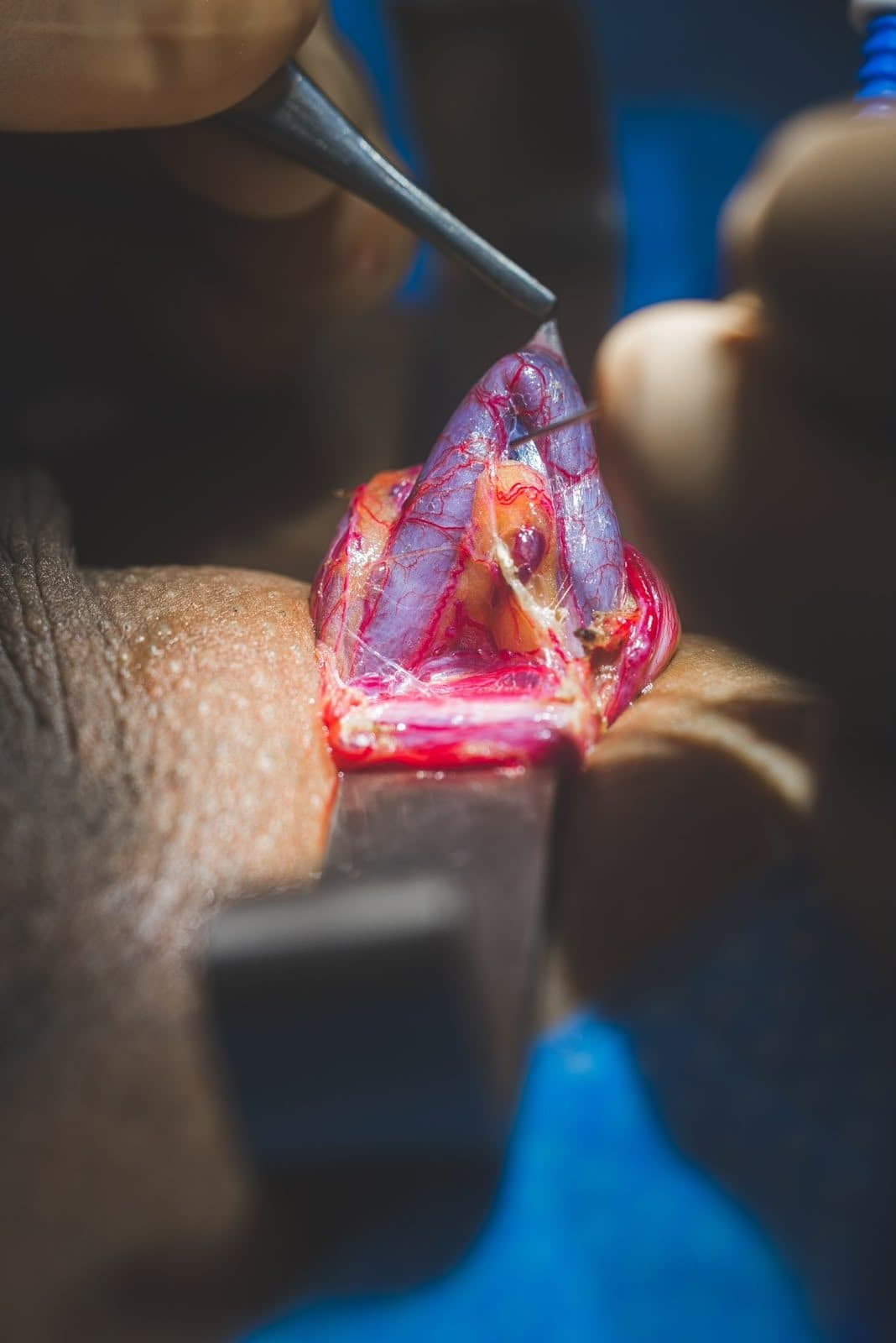 Reproductive microsurgery under a microscope